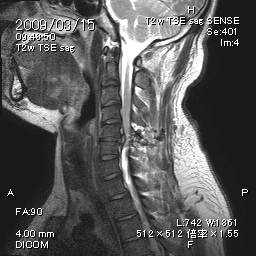 頸椎椎間板ヘルニア　C5-6   術後矢状断　