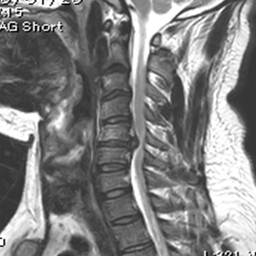 頸椎椎間板ヘルニア　C5-6   術前矢状断　