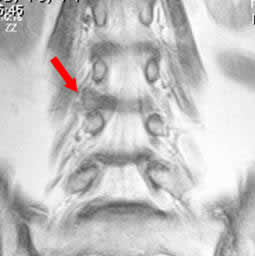 超外側型椎間板ヘルニア　右L3/4  術後MRI  冠状断像