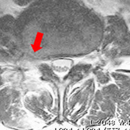 超外側型椎間板ヘルニア　右L3/4  術後MRI  横断