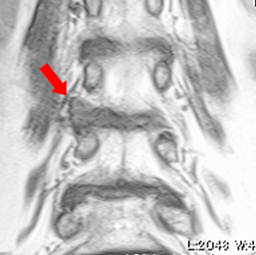 超外側型椎間板ヘルニア　右L3/4  　術前MRI  冠状断像