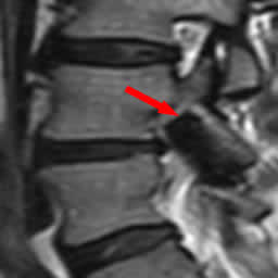 椎間孔狭窄右L4-5　術前　冠状断像