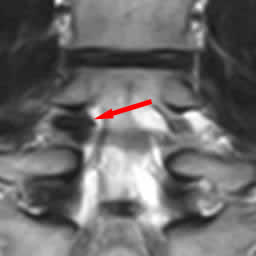 椎間孔狭窄右L4-5　術前　冠状断