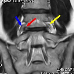 　　左L4-5  FLDH  術前MRI 冠状断